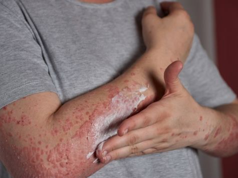 PSORIASIS BIENFAITS DE LEAU DE MER