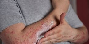 PSORIASIS BIENFAITS DE LEAU DE MER